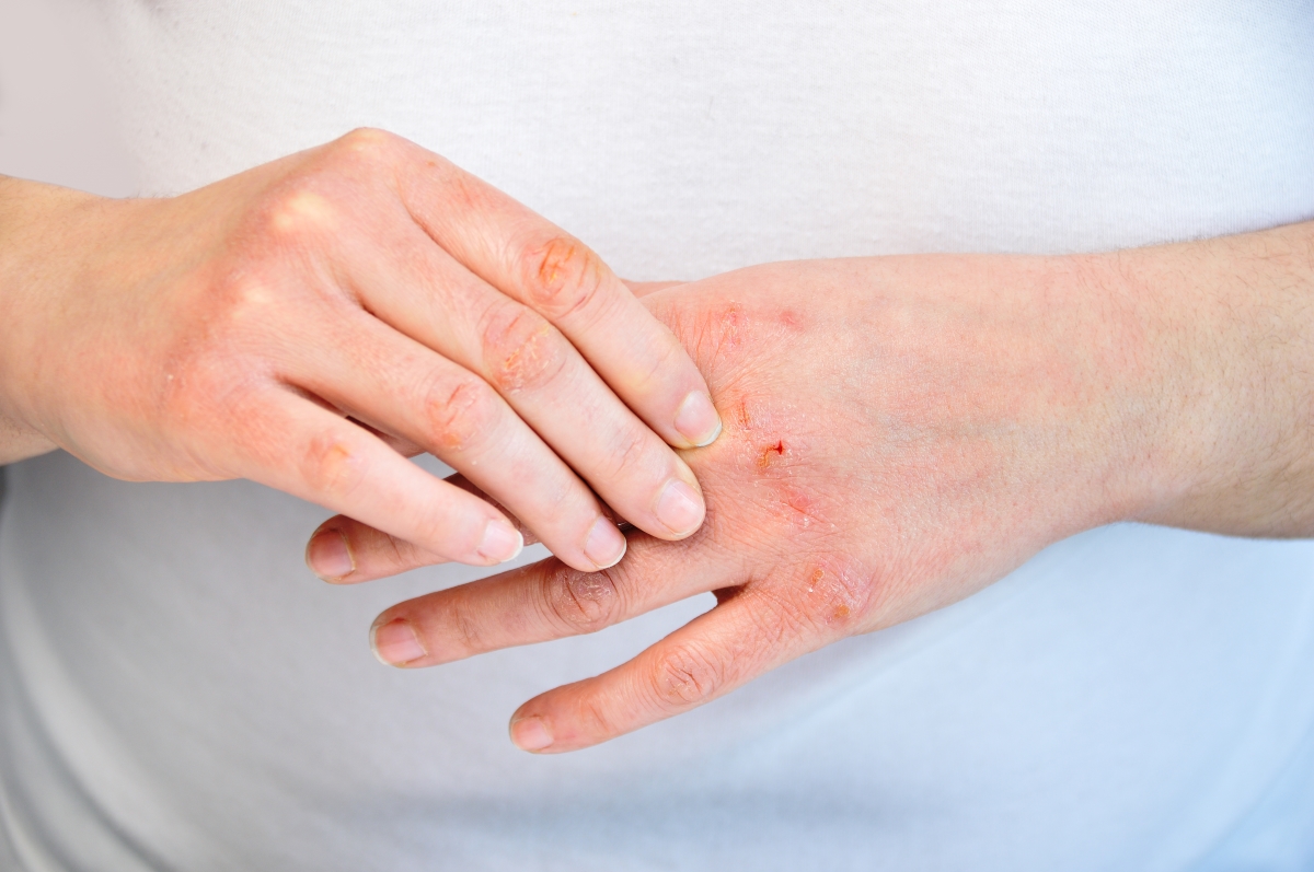 9 Treatment Options for Eczema